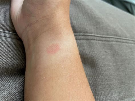 fake watch cause itchy rash|does watch rash hurt.